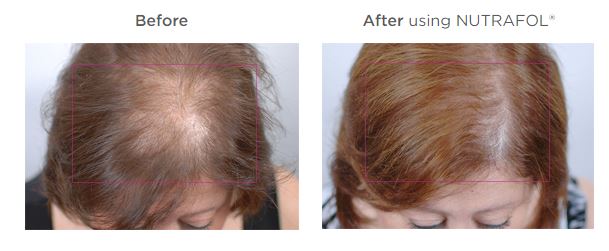 womans hair loss image